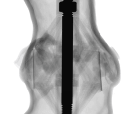 pre-procedural-fit-testing-transcatheter-aortic-valve-replacement-tavr-valves-using-parametric-modeling-3d-printing